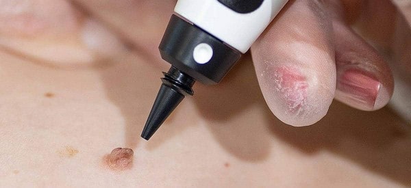 After Skin Tag Removal Oxshott