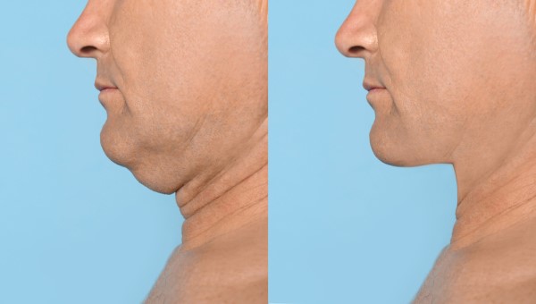 Which Non-Surgical Treatments Work Best for Jowls and Loose Skin Oxshott?