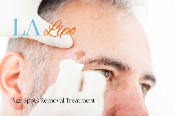 What Are the Most Effective Treatments for Age Spots Oxshott?