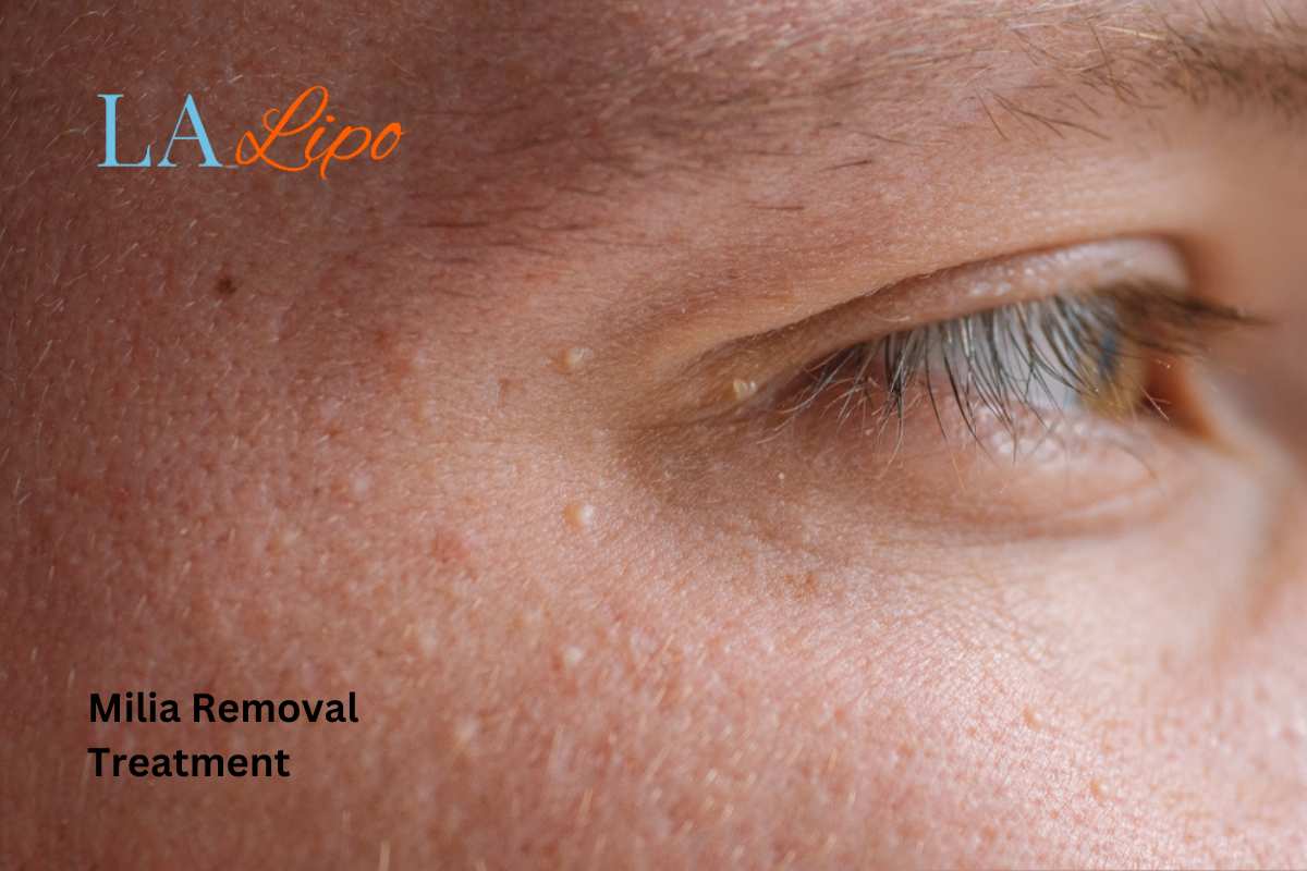 Cryopen Milia Removal: Is It the Easiest and Safest Option Oxshott?
