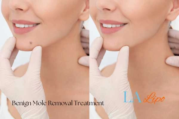 woman's before and after mole removal Oxshott results