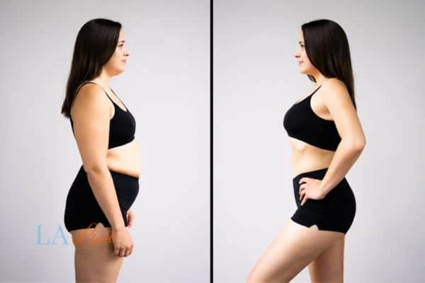 image of woman before and after results of LA-EMS Body Sculpting Oxshott to help treat Diastasis recti