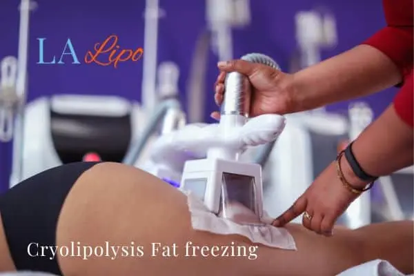 women getting fat freezing Oxshott