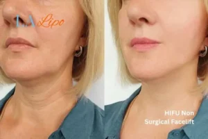 hi-fu for wrinkles Oxshott before and after results