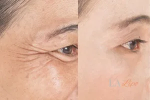 Before and after results of woman - HI-fu wrinkles reduction treatment Oxshott