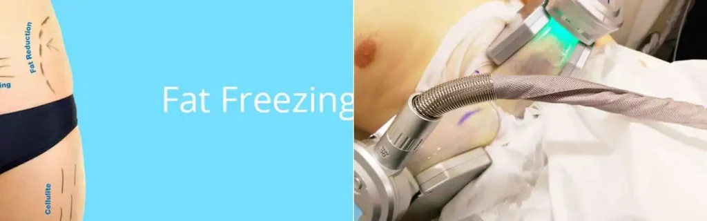 Fat freezing Oxshott on multiple areas of the body