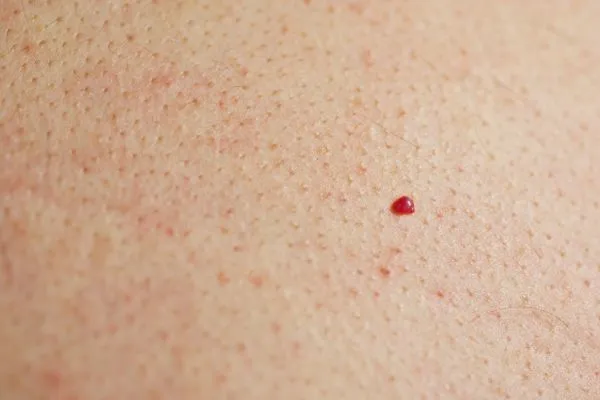 close up of a cherry angioma Oxshott