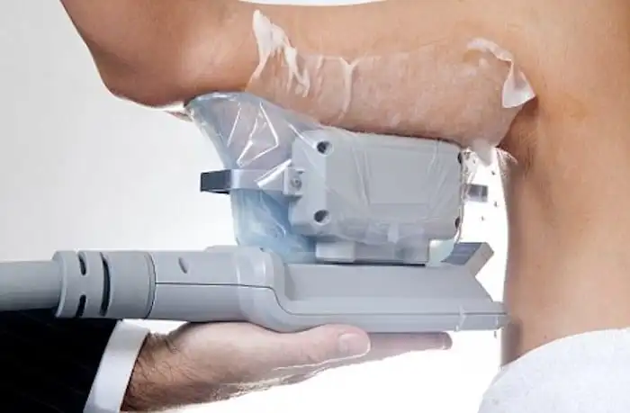 Picture of fat freezing Oxshott on the upper arms.
