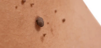 image of a skin tag Oxshott
