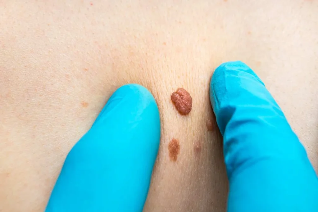 Consultant examining a skin tag Oxshott