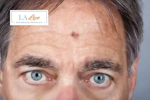 Solar Lentigo Removal Oxshott image of man with mark on his forehead