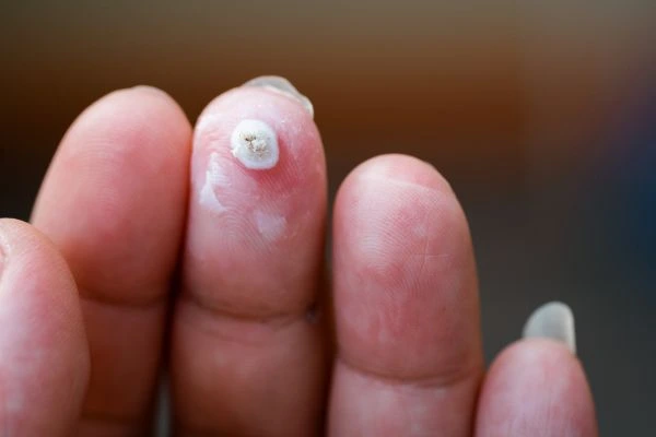 wart on person finger - cryotherapy to treat from LA LIPO Oxshott