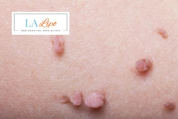 Does cryopen skin tag removal Oxshott hurt? Find out now call our team today!