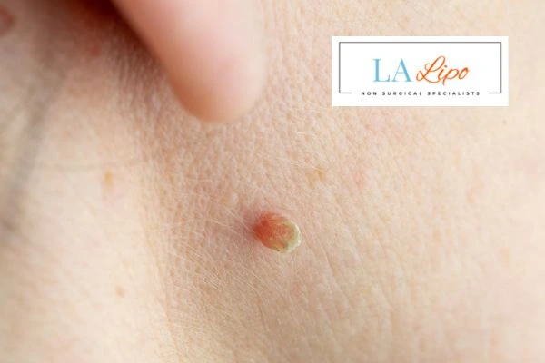 Book skin tag removal Oxshott today speak to our team now!