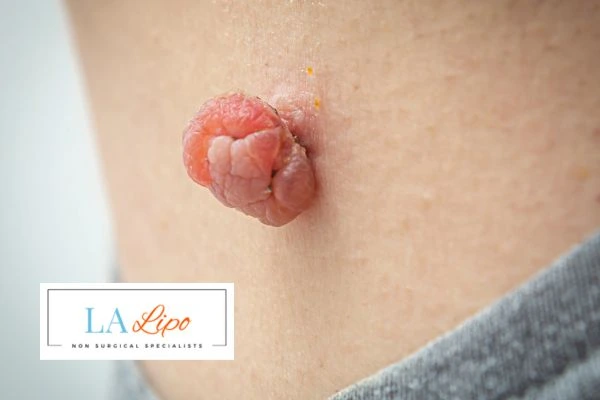 Interested in skin tag removal Oxshott? Concerned about the pain? Find out more today!