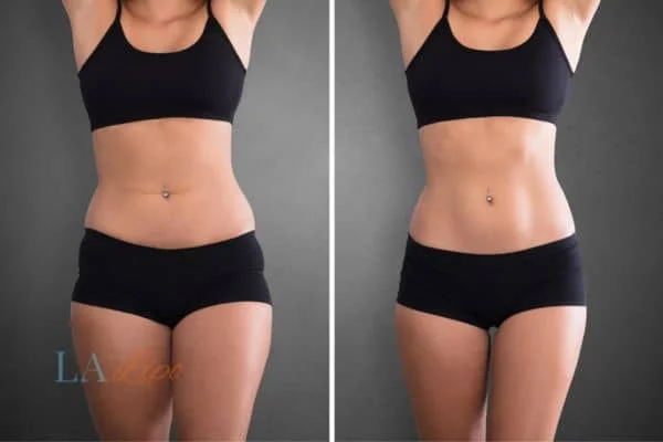 before and after results of non-surgical treatment to help a woman's body image and mental health Oxshott