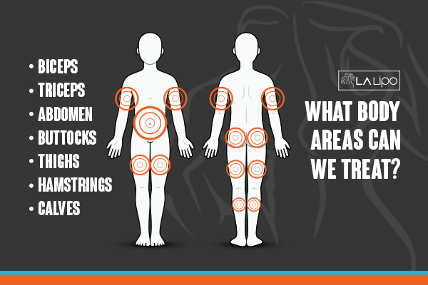 Diagram to show areas you can have LA-EMS Body Sculpting Treatment Oxshott