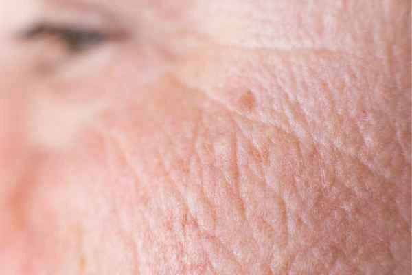 close up picture of a woman's face showing an age spot Oxshott