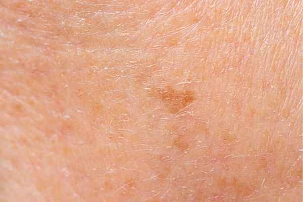 close up picture of age spots Oxshott