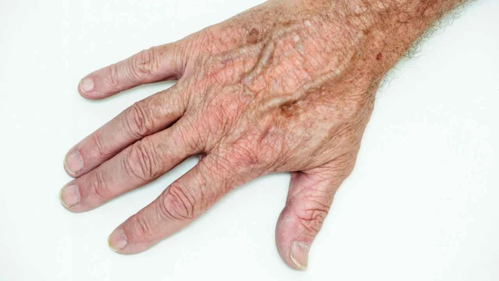 Male hand showing age spot Oxshott