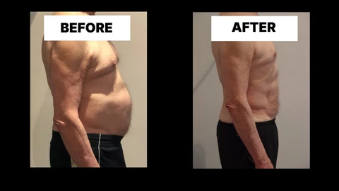 What Symptoms Can Diastasis Recti Cause in Men? Weak Core, Back Pain and Poor Posture Oxshott